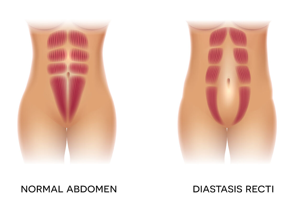 Diastasis recti is the partial or complete separation of the rectus abdominis, or “six-pack” muscles, which meet at the midline of the stomach. Diastasis recti is very common during and following pregnancy.